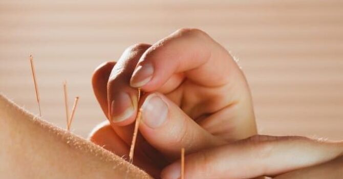 The Surprising Benefits of Acupuncture image